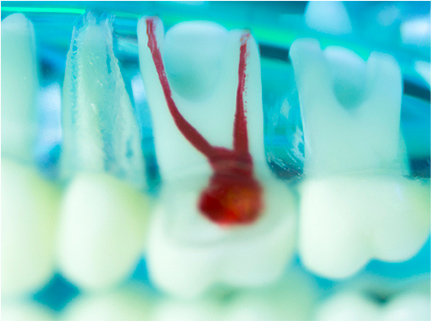 他院では抜歯と言われても、歯が残せる精密な根管治療