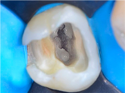 歯髄保存治療（歯の神経を残す治療）