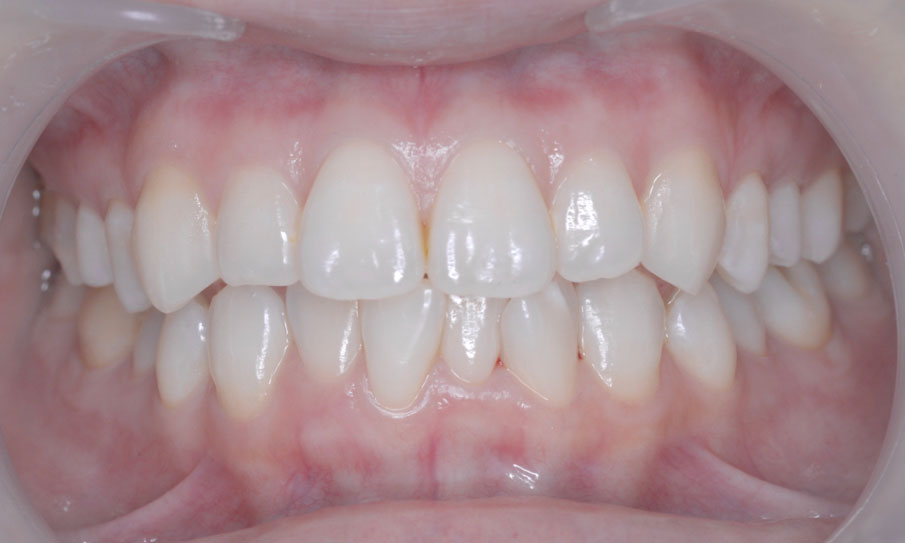 ホワイトニング春日市の歯医者・春日THREE歯科でのホワイトニング症例（施術後）