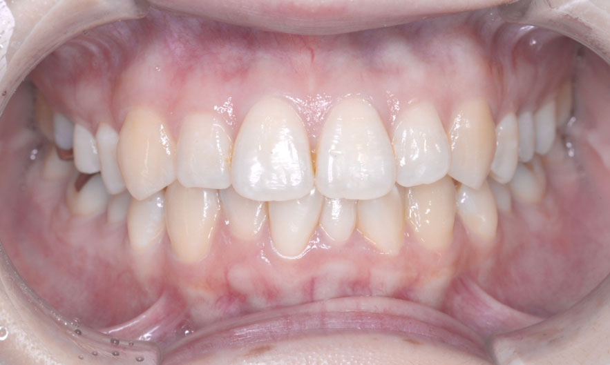 ホームホワイトニング春日市の歯医者・春日THREE歯科でのホワイトニング症例（施術前）