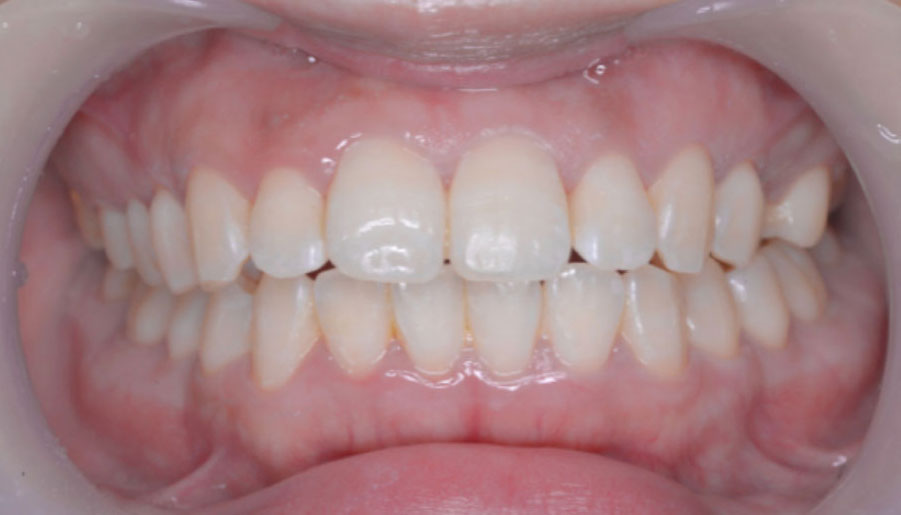 オフィスホワイトニング春日市の歯医者・春日THREE歯科でのホワイトニング症例（施術後）