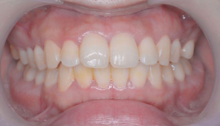 オフィスホワイトニング春日市の歯医者・春日THREE歯科でのホワイトニング症例（施術前）