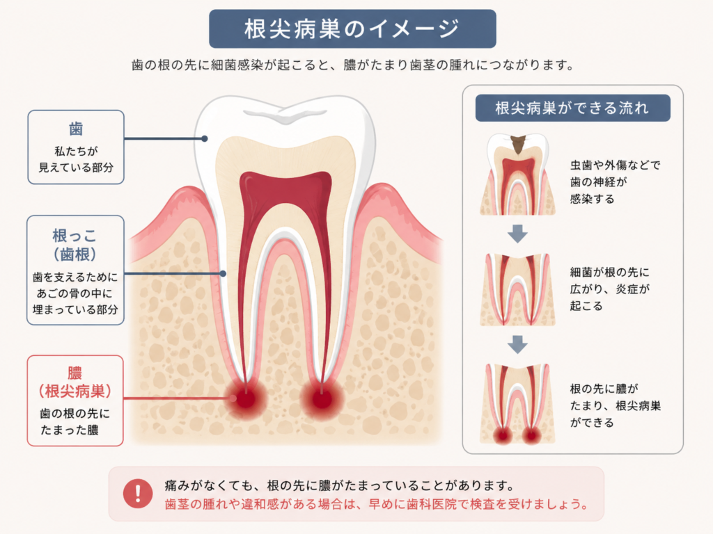 根尖病巣のイラスト解説