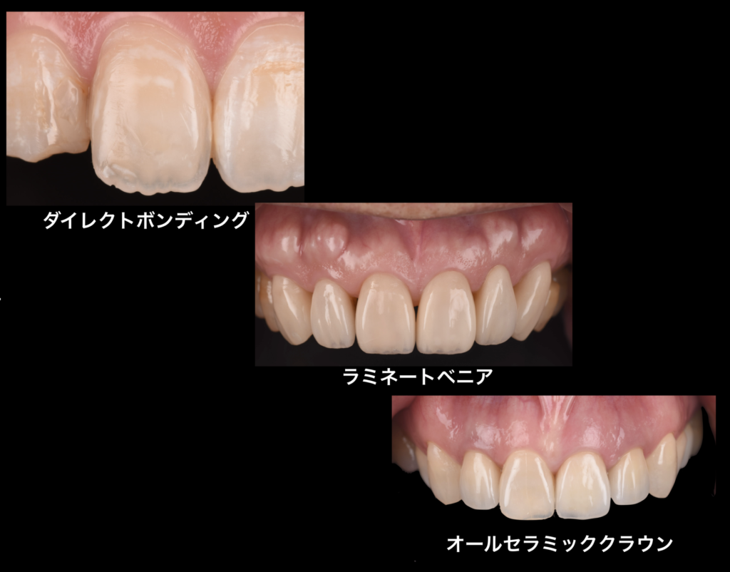 前歯の中くらいの欠けに対する治療例
